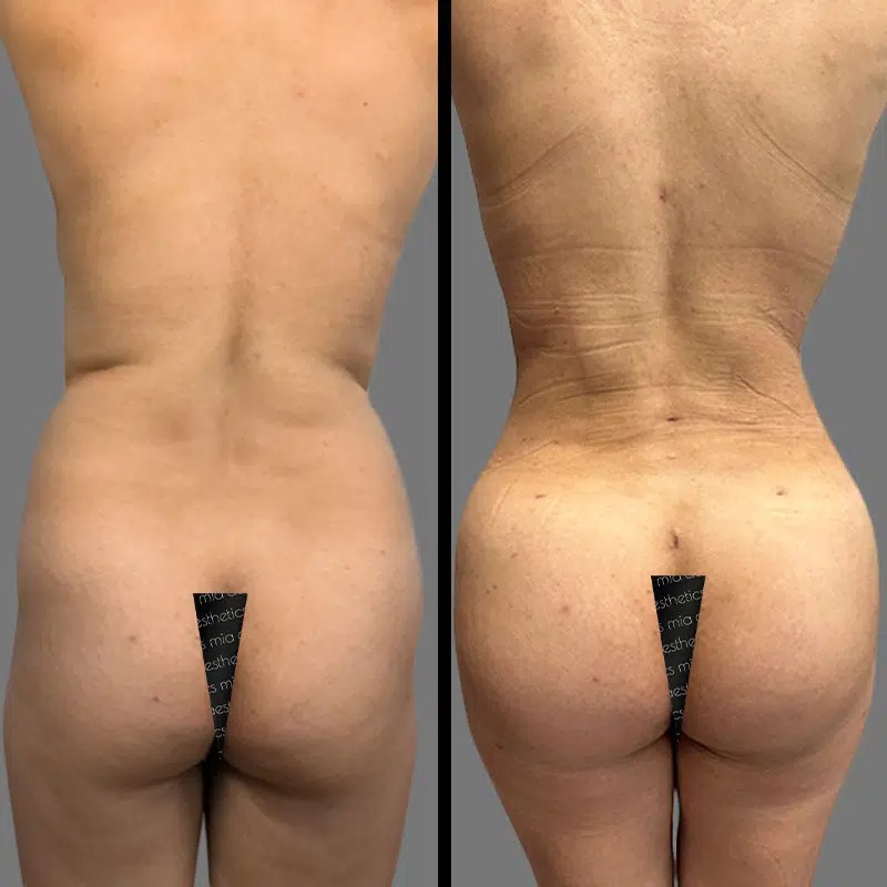 Dr. Sarcia • Brazilian Butt Lift (BBL) • image 5