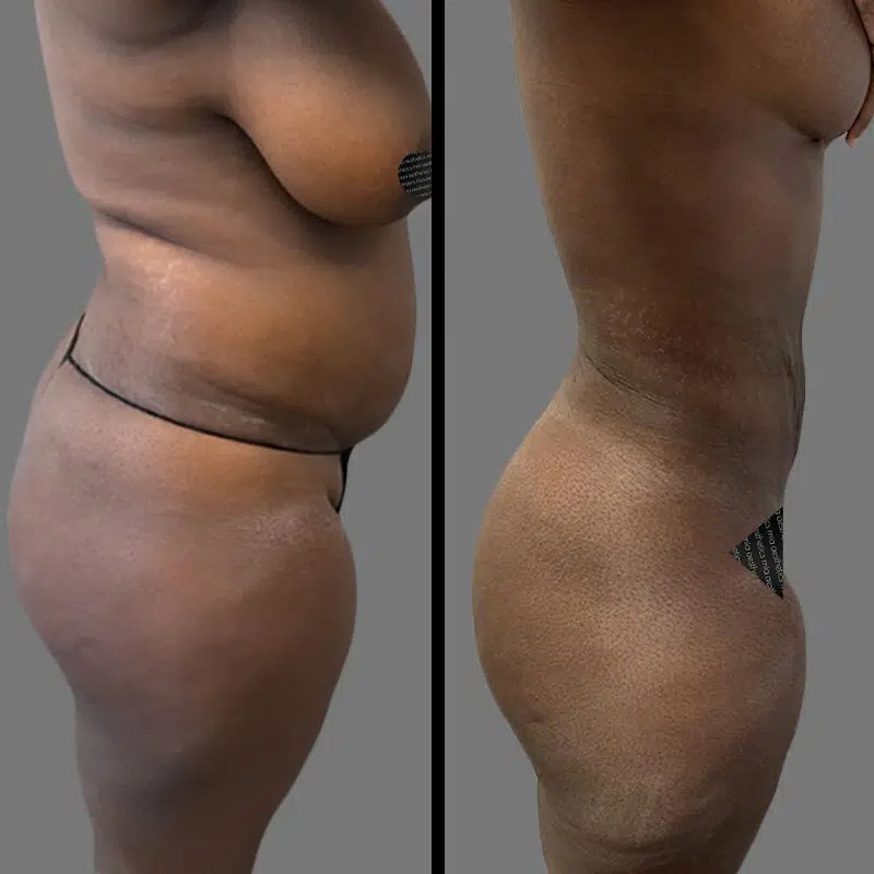 Dr. Sarcia • Lipo 360 • image 3