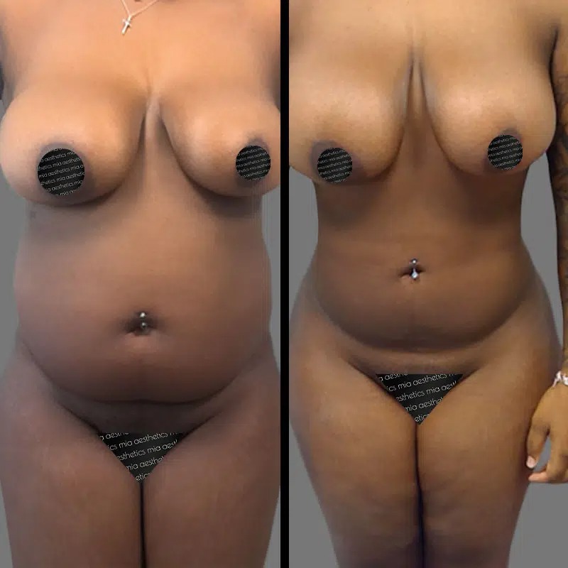 Dr. Sarcia • Lipo 360 • image 4