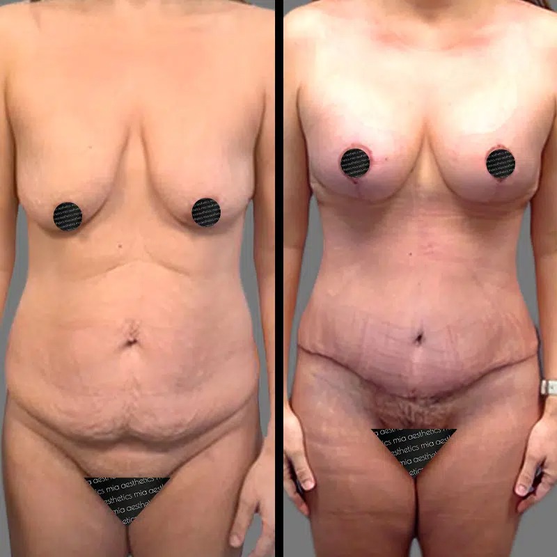 Dr. Sarcia • Mommy Makeover • image 1
