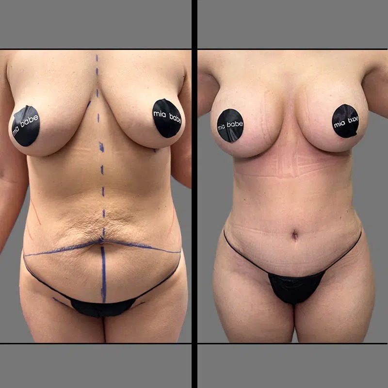 Dr. Sarcia • Mommy Makeover • image 4