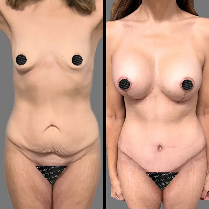 Dr. Sarcia • Mommy Makeover • image 5
