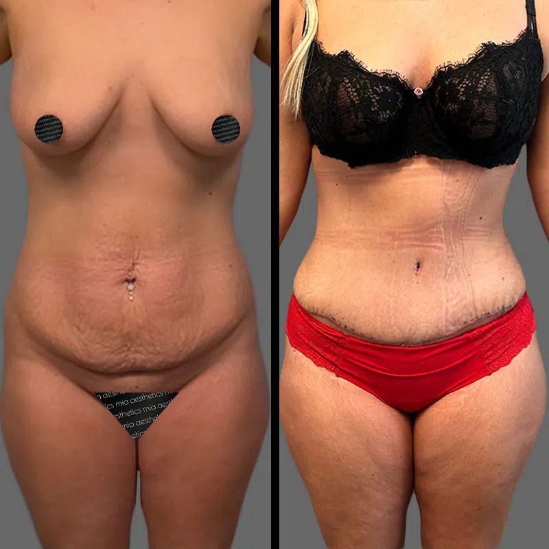 Dr. Sarcia • Tummy Tuck • image 3