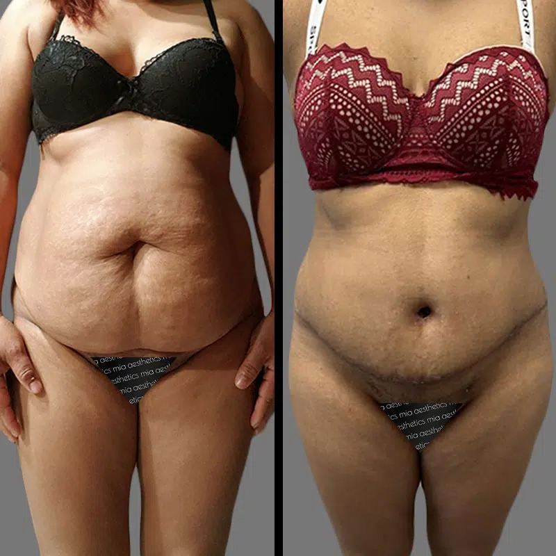 Dr. Sarcia • Tummy Tuck • image 5