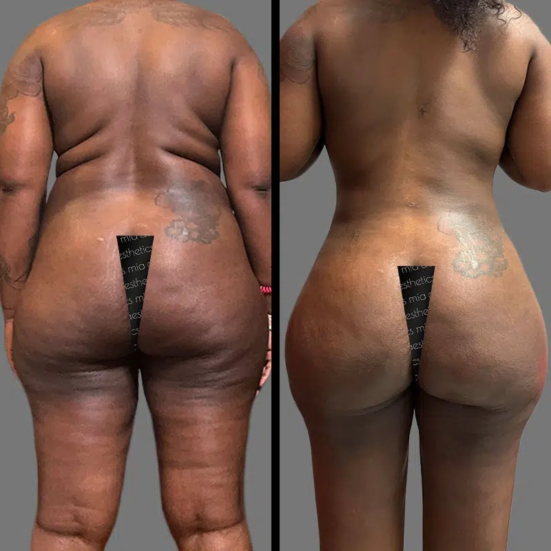 Dr. Scroggins • Brazilian Butt Lift (BBL) • image 1