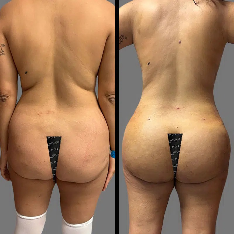 Dr. Scroggins • Brazilian Butt Lift (BBL) • image 2
