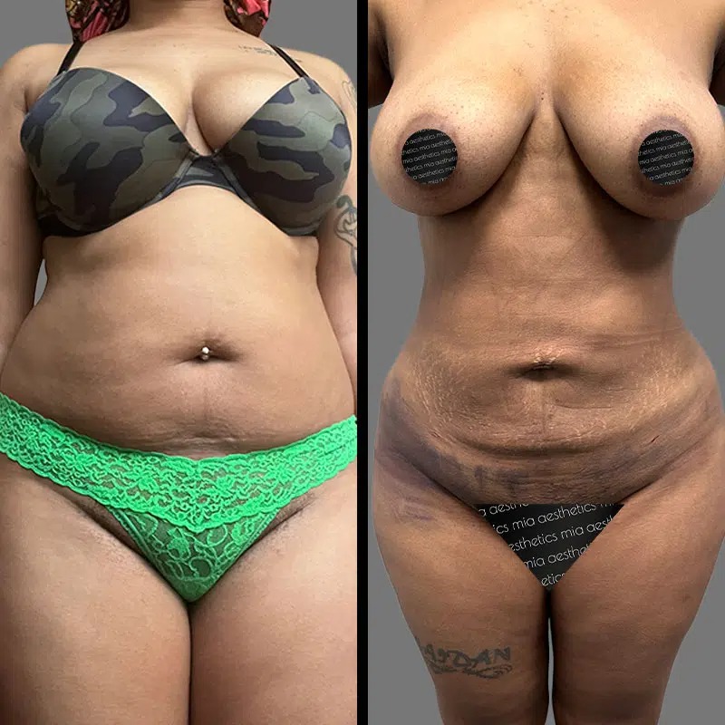 Dr. Scroggins • Lipo 360 • image 3