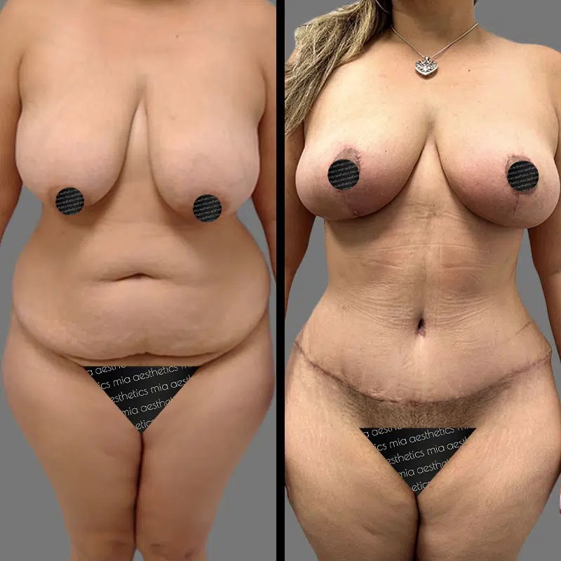 Dr. Scroggins • Mommy Makeover • image 1