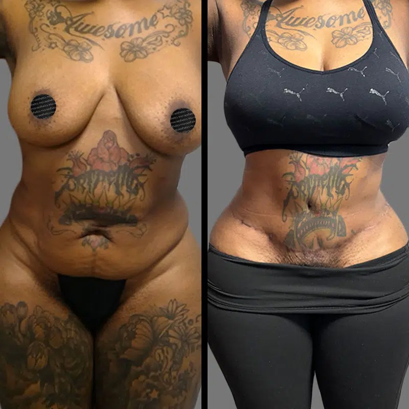 Dr. Scroggins • Tummy Tuck • image 1