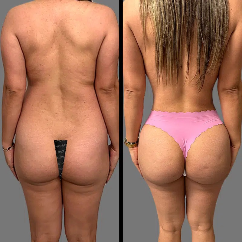 Dr. Shaikh • Brazilian Butt Lift (BBL) • image 1