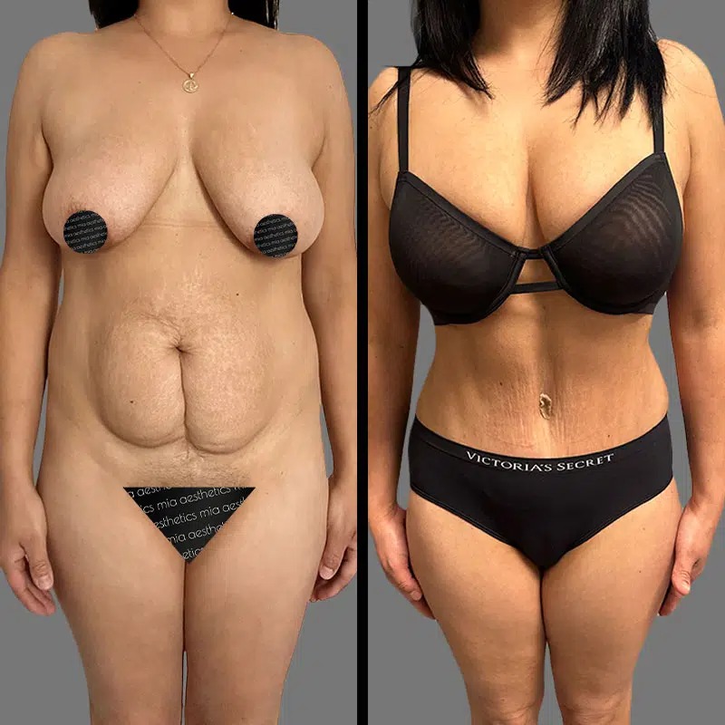 Dr. Shaikh • Tummy Tuck • image 3