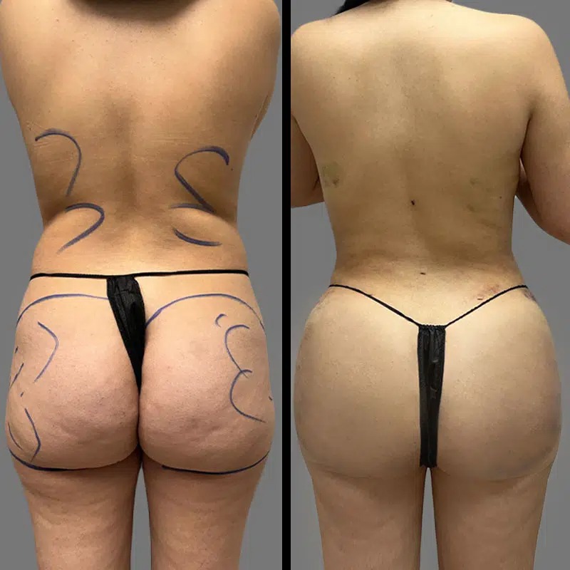 Dr. Towle • Brazilian Butt Lift (BBL) • image 1