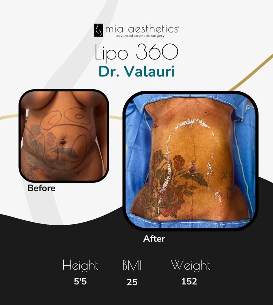 Dr. Valauri • Lipo 360 • image 2