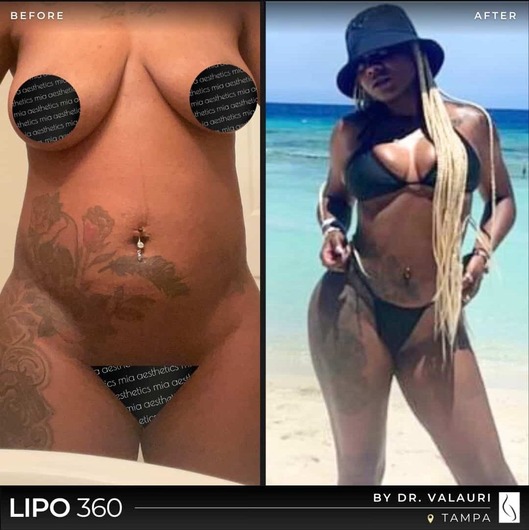 Dr. Valauri • Lipo 360 • image 3