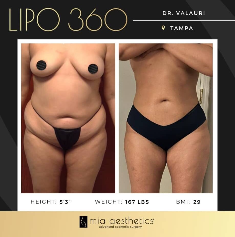 Dr. Valauri • Lipo 360 • image 4