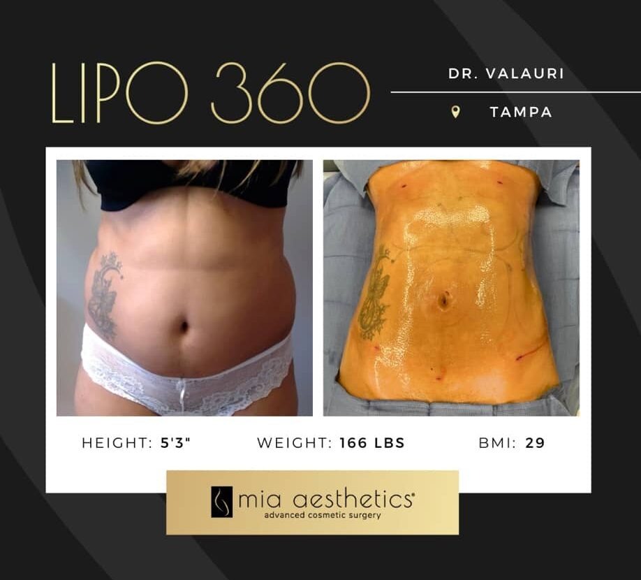Dr. Valauri • Lipo 360 • image 1