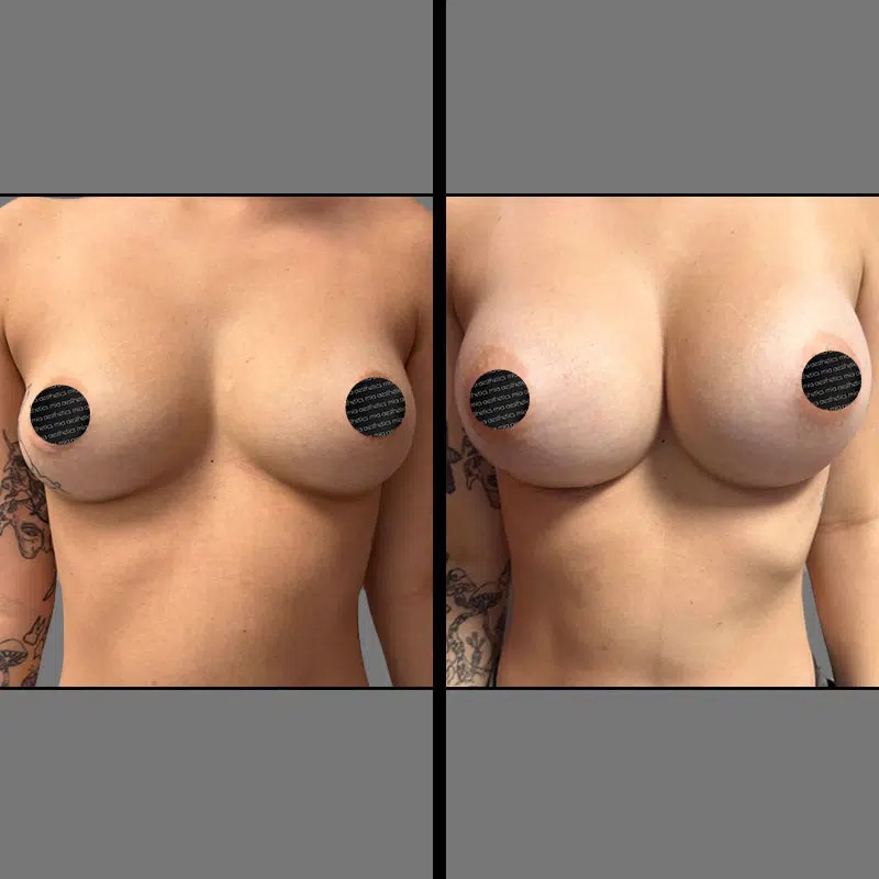 Dr. Valauri • Breast Procedures • image 2