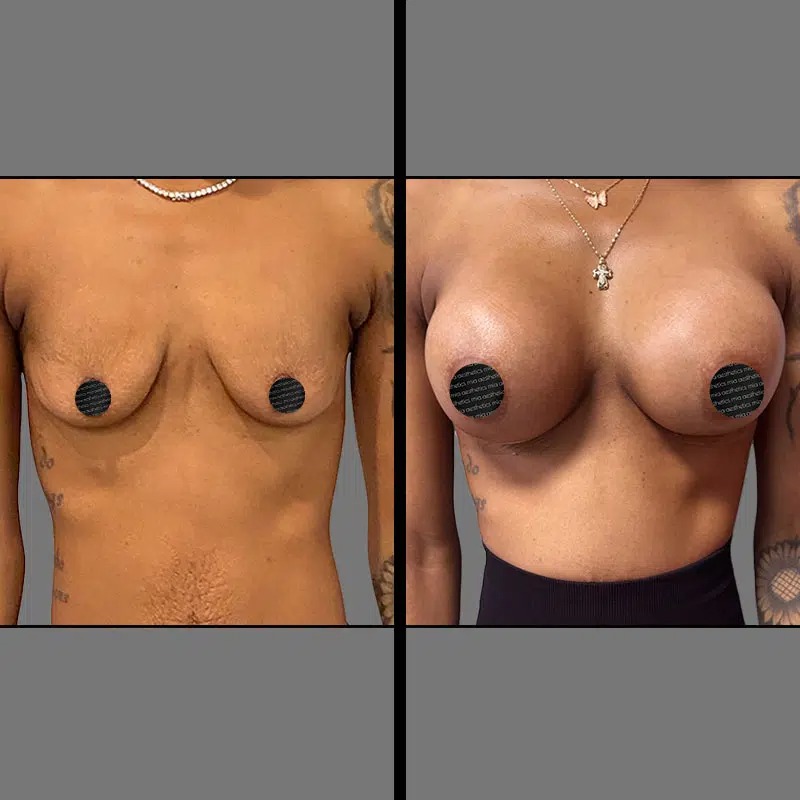 Dr. Valauri • Breast Procedures • image 3
