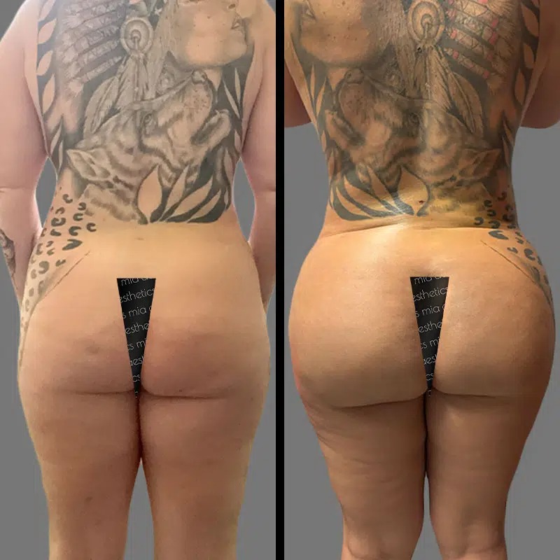 Dr. Valauri • Brazilian Butt Lift (BBL) • image 1