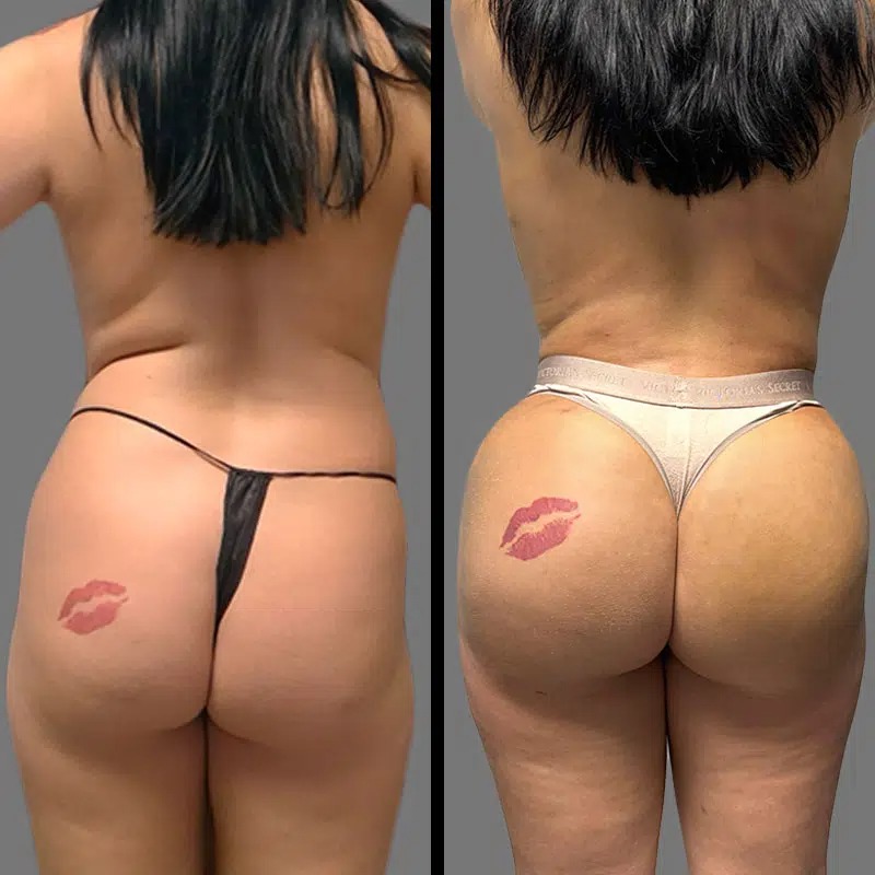 Dr. Valauri • Brazilian Butt Lift (BBL) • image 2