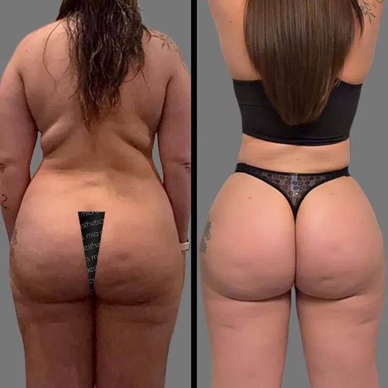 Dr. Valauri • Brazilian Butt Lift (BBL) • image 5