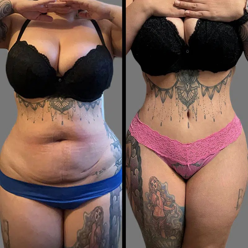Dr. Valauri • Tummy Tuck • image 1