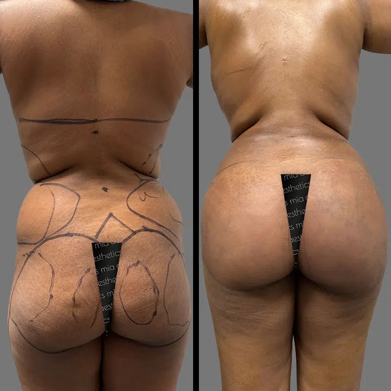 Dr. Wright • Brazilian Butt Lift (BBL) • image 3
