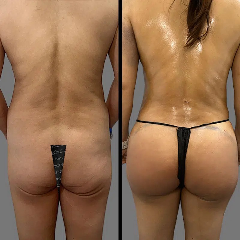 Dr. Wright • Brazilian Butt Lift (BBL) • image 4