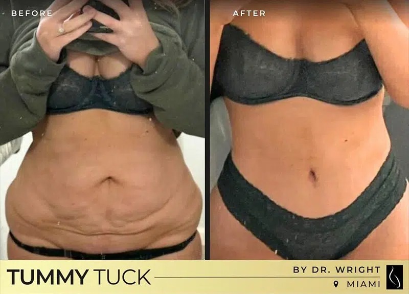 Dr. Wright • Tummy Tuck • image 3