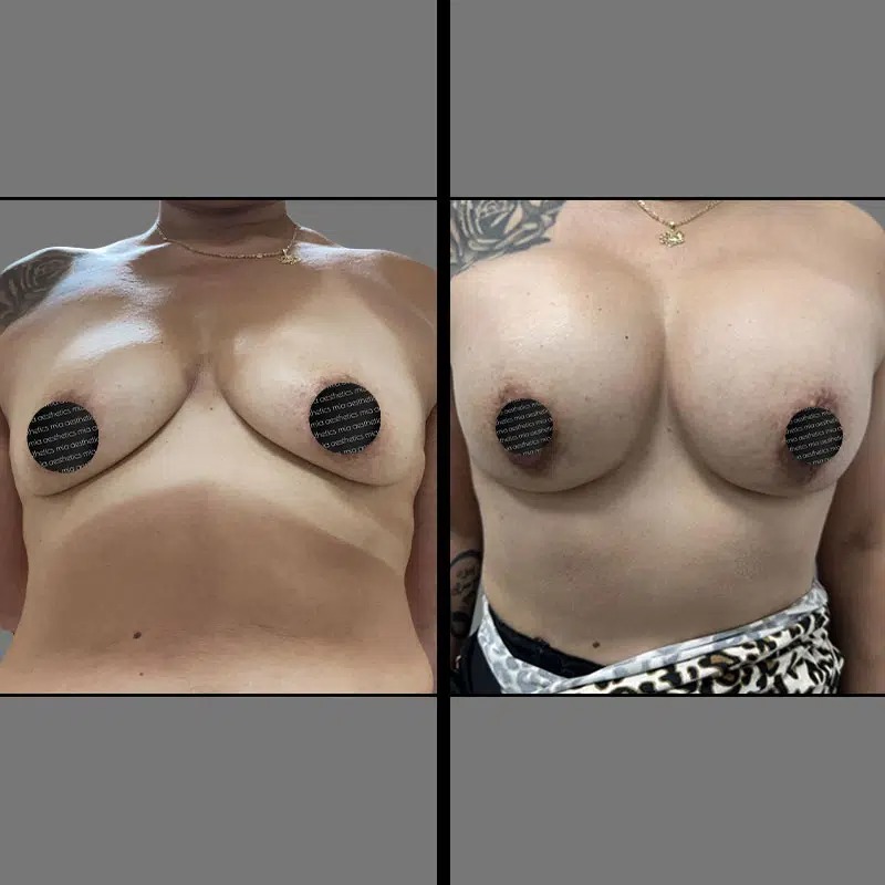 Dr. Xu • Breast Procedures • image 2