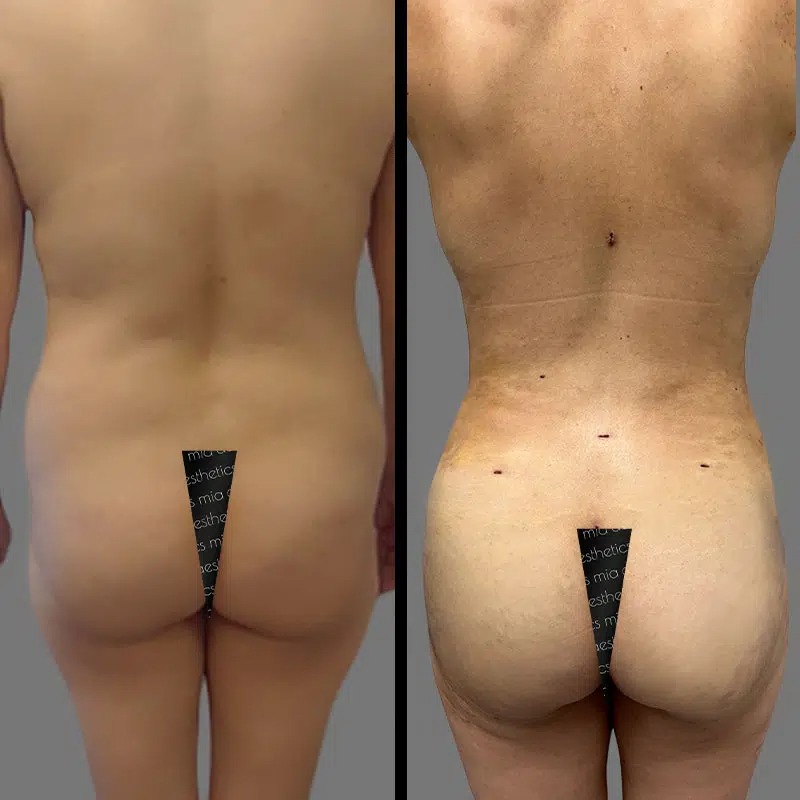 Dr. Xu • Brazilian Butt Lift (BBL) • image 1