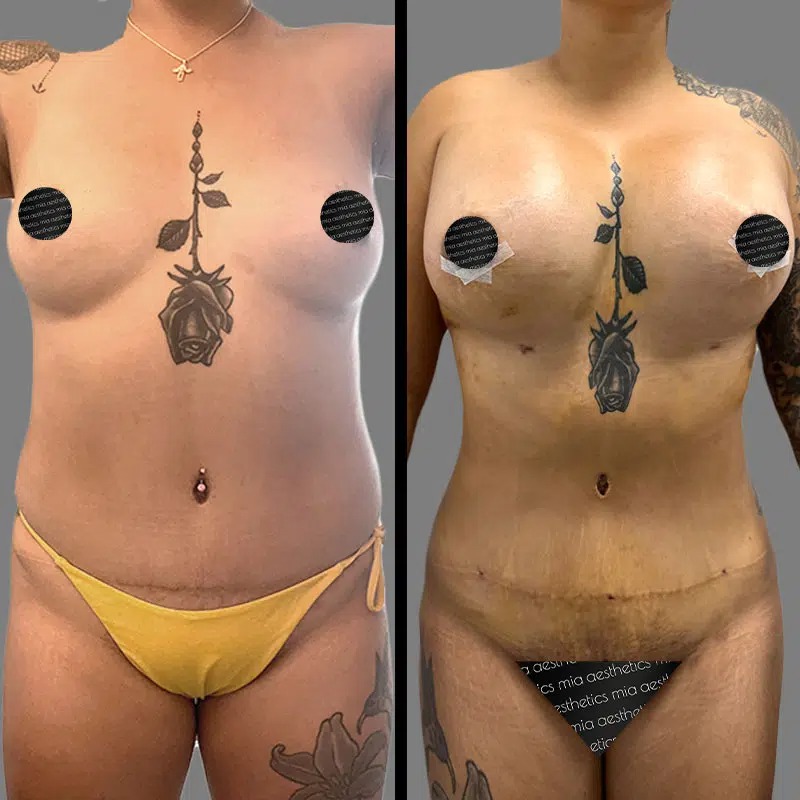 Dr. Xu • Mommy Makeover • image 1