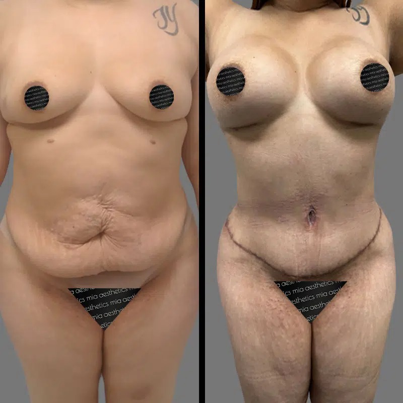 Dr. Xu • Mommy Makeover • image 3