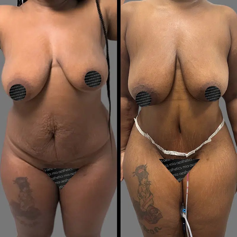 Dr. Xu • Tummy Tuck • image 1