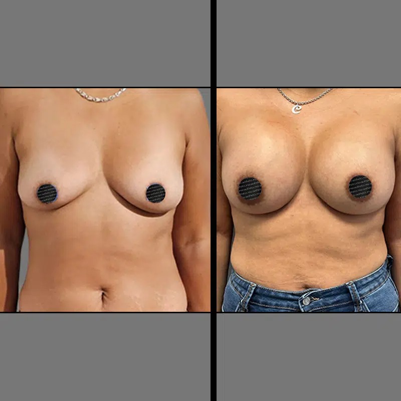 Dr. Ziakas • Breast Procedures • image 2