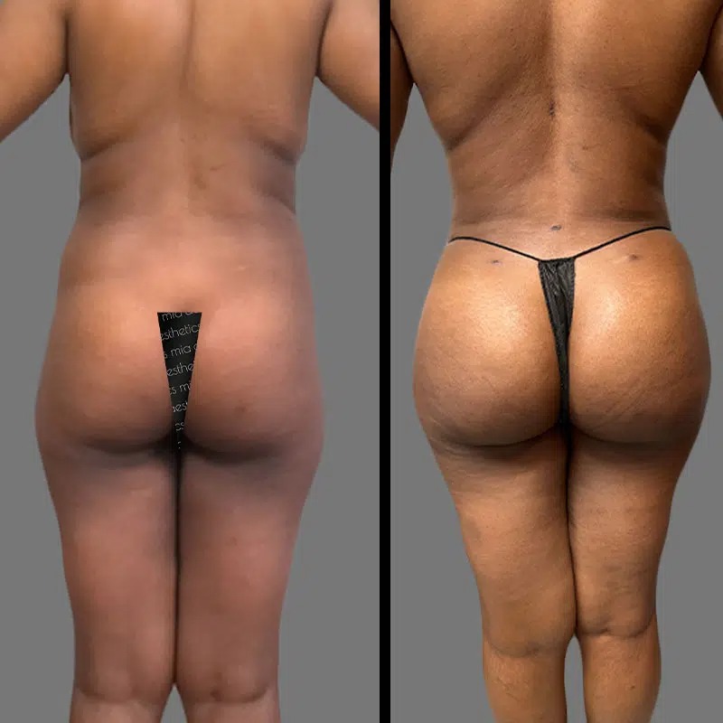 Dr. Ziakas • Brazilian Butt Lift (BBL) • image 1