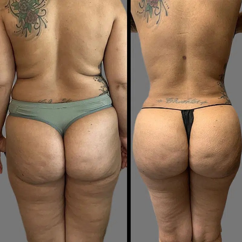 Dr. Ziakas • Brazilian Butt Lift (BBL) • image 2