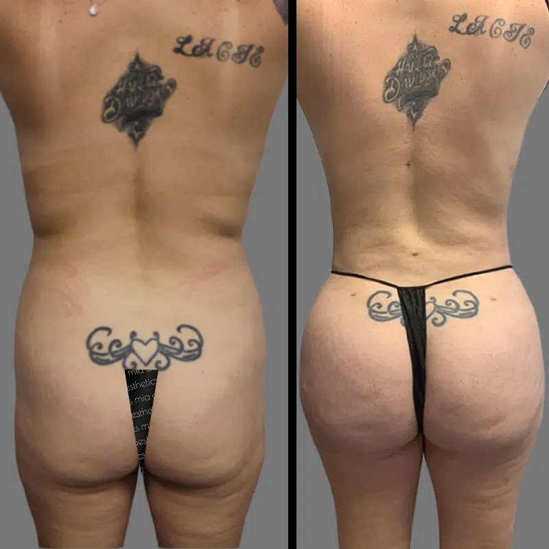 Dr. Ziakas • Brazilian Butt Lift (BBL) • image 3