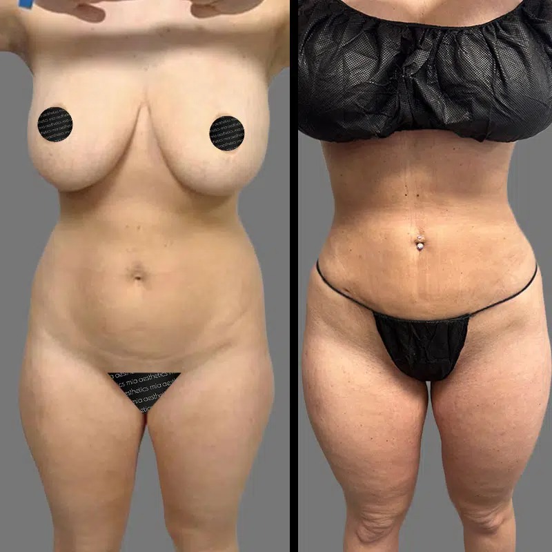 Dr. Ziakas • Lipo 360 • image 1