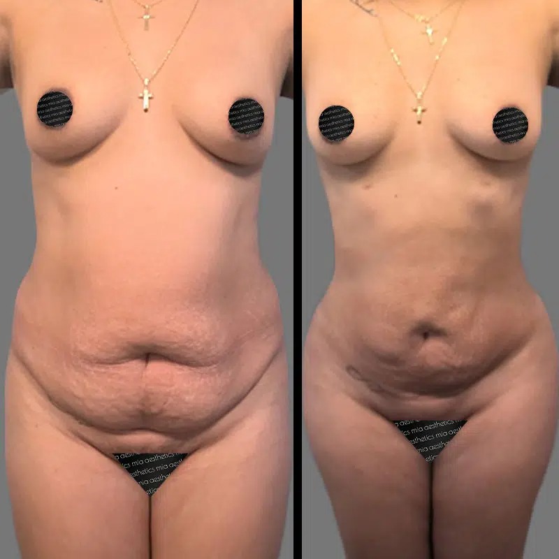 Dr. Ziakas • Lipo 360 • image 3