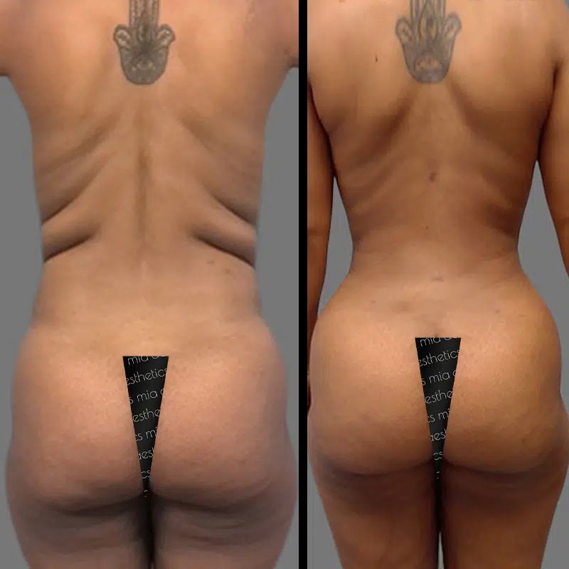 Dr. Ziakas • Lipo 360 • image 5