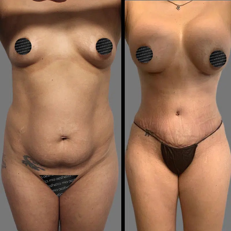 Dr. Ziakas • Mommy Makeover • image 2