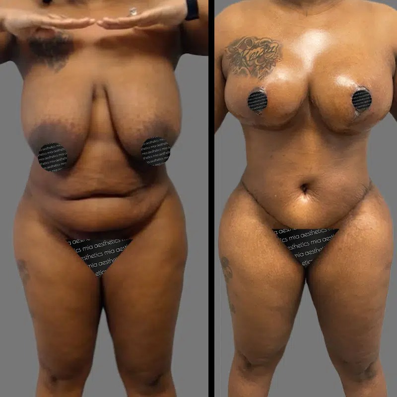 Dr. Ziakas • Mommy Makeover • image 3