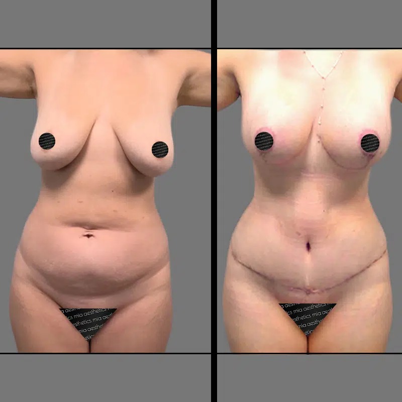 Dr. Ziakas • Mommy Makeover • image 5