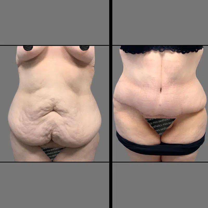 Dr. Ziakas • Tummy Tuck • image 1