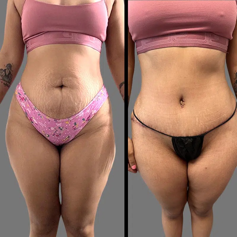 Dr. Ziakas • Tummy Tuck • image 3