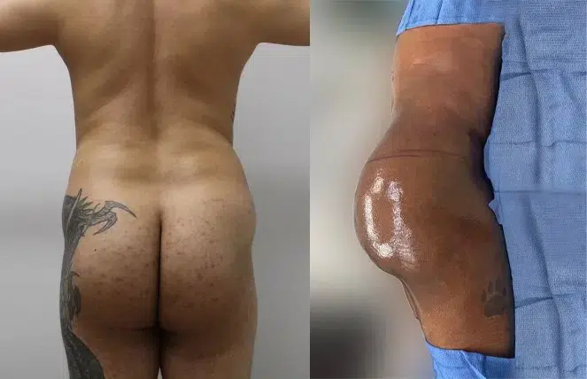 Male BBL Case Study - Patient Results