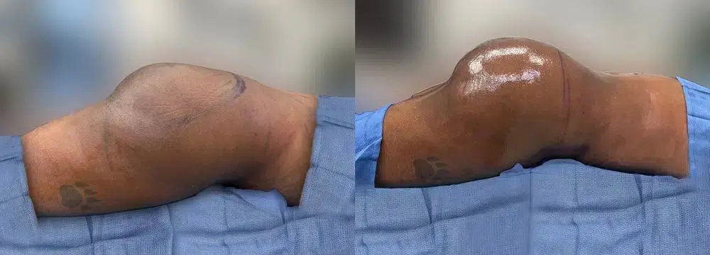 Male BBL Before and After
