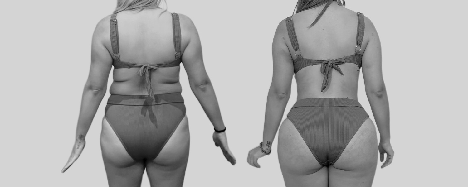 Before & After Gallery Results - Mia Aesthetics