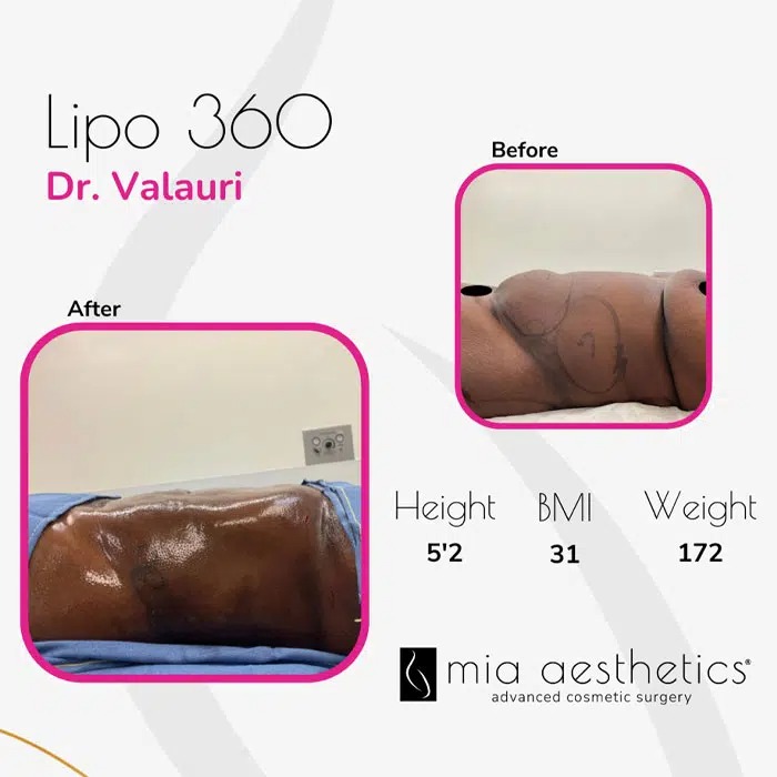 Dr. Valauri • Lipo 360 • image 5